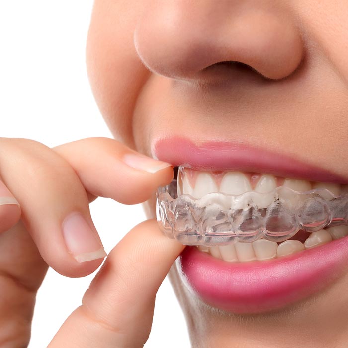 歯並び実話体験談 透明な矯正装置がすごい